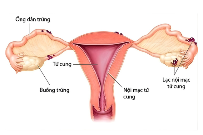 Tình trạng lạc nội mạc gây viêm nhiễm và khiến phụ nữ khó mang thai tự nhiên