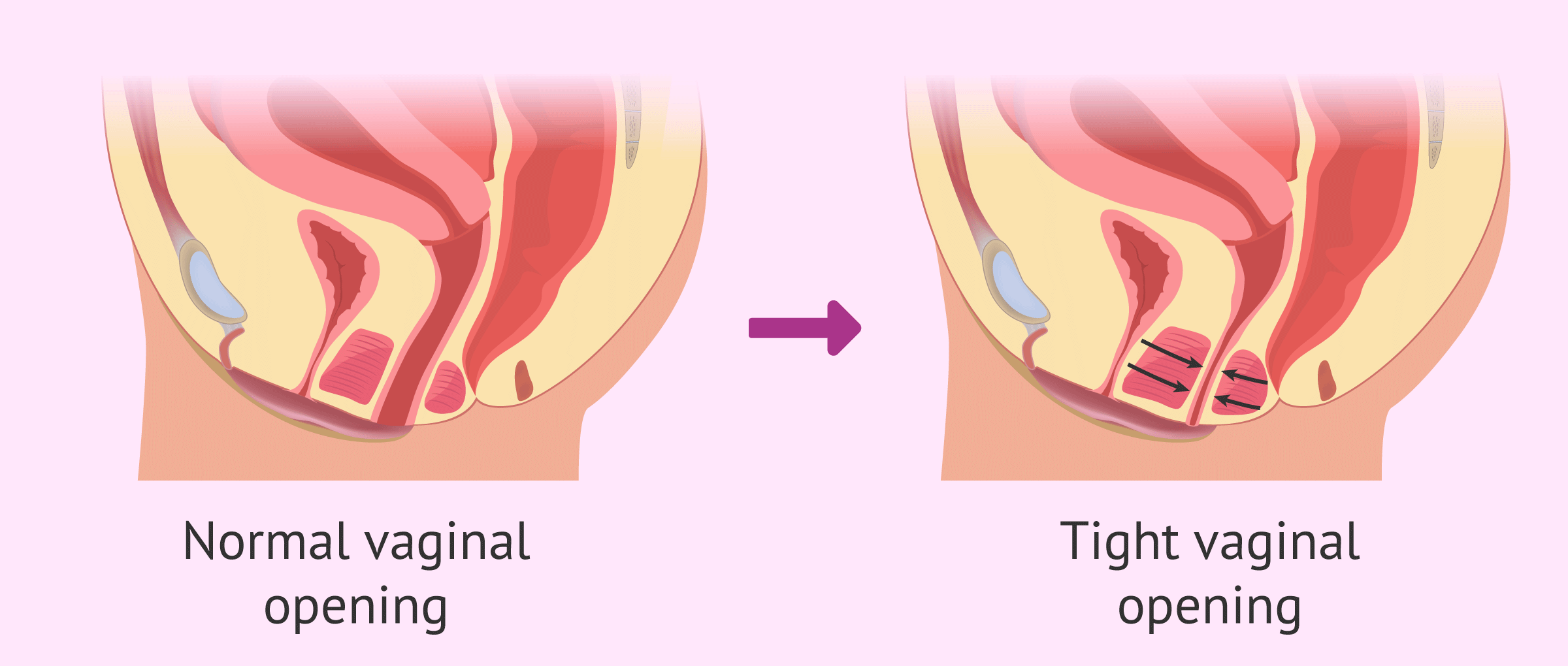 Co thắt âm đạo ngoài ý muốn (Vaginismus)