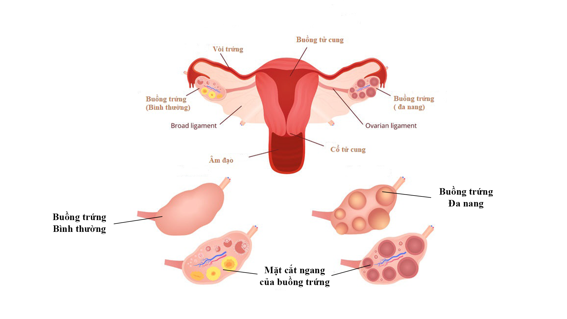 Dấu hiệu u nang buồng trứng lành tính