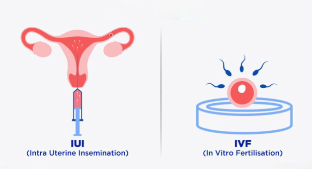 Lạc nội mạc buồng trứng có nên làm IUI