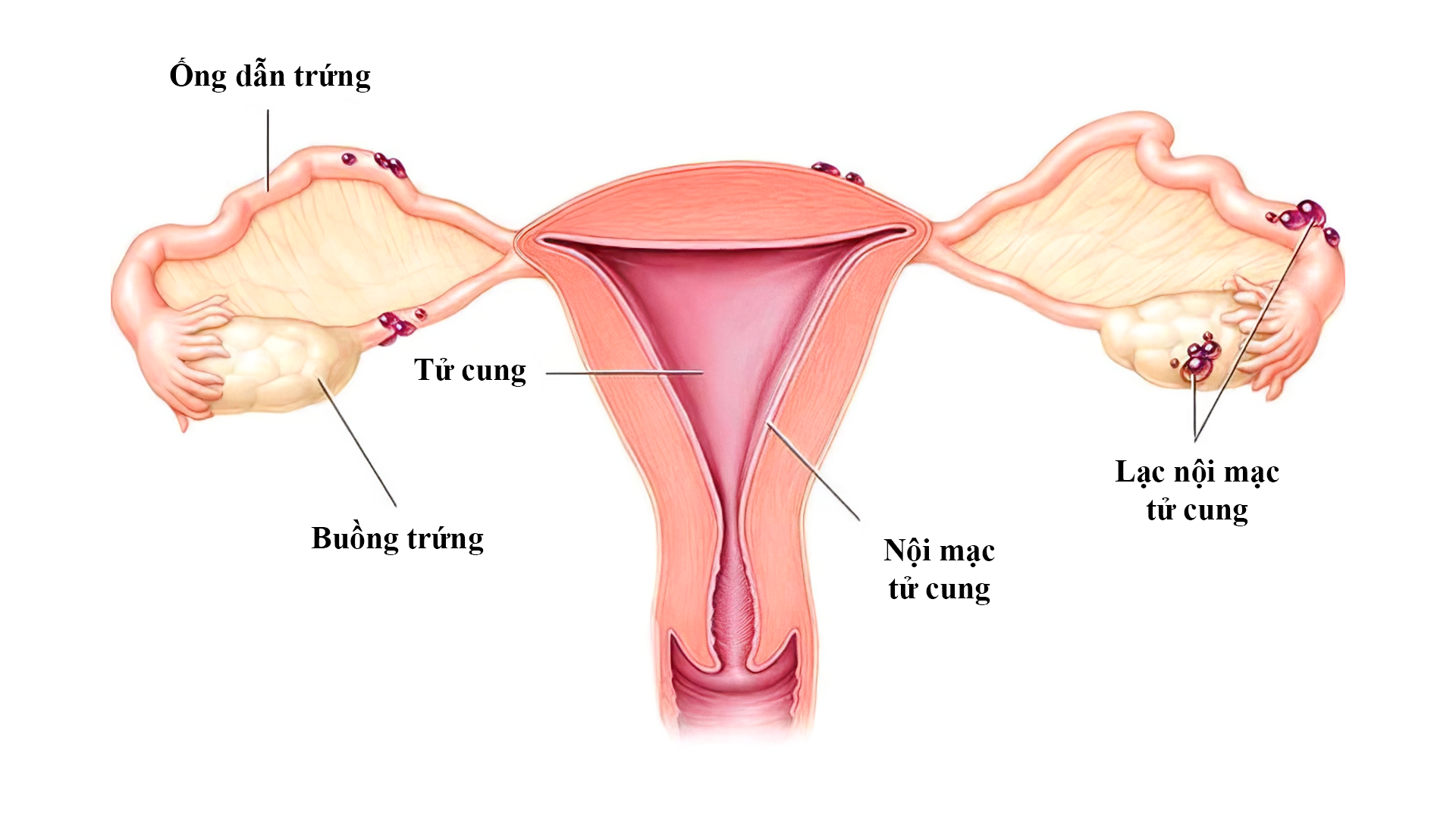 Lạc nội mạc tử cung