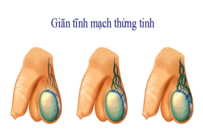 Mổ Giãn Tĩnh Mạch Thừng Tinh Xong Có Bị Tái Phát Không