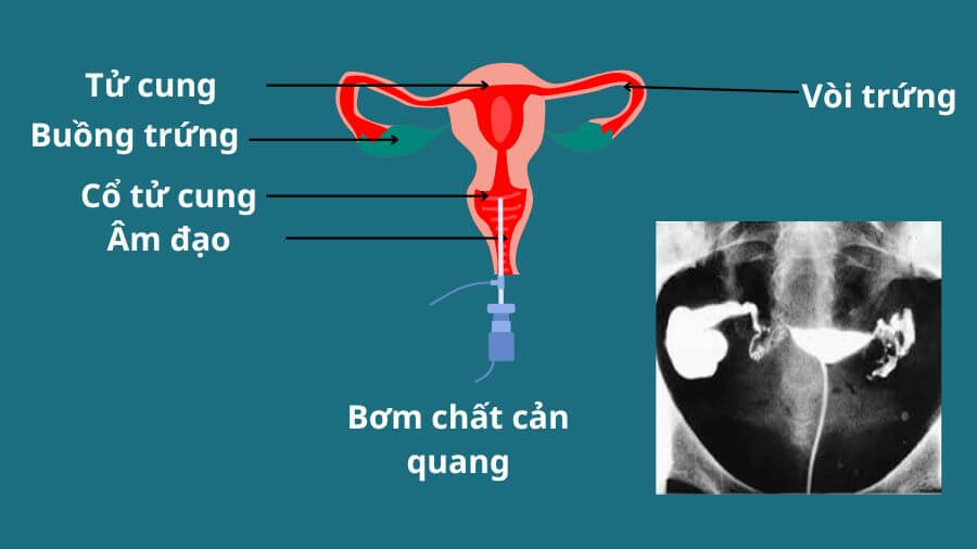 Ứ dịch vòi trứng có chuyển phôi được không