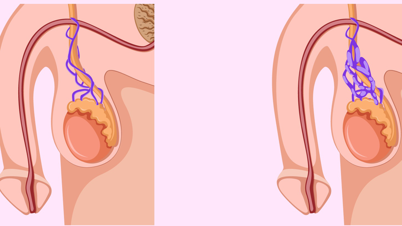 Varicocele là gì
