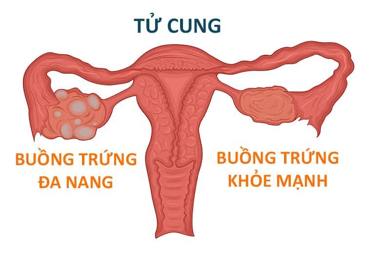 buồng trứng đa nang (PCOS)