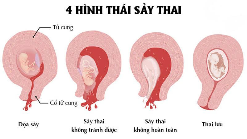 các hình thái sảy thai