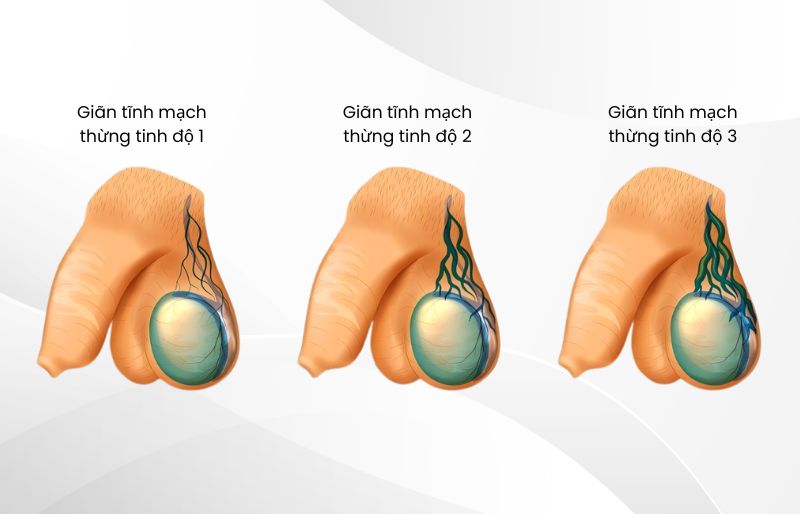 giãn tĩnh mạch thừng tinh