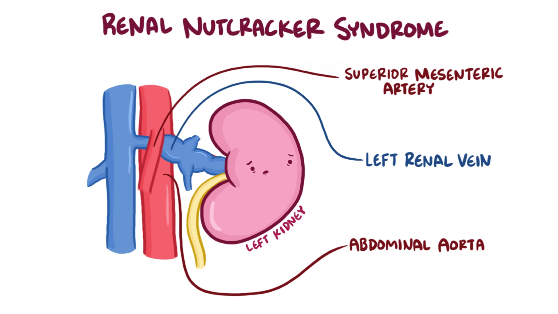 hiện tượng kẹp hạt dẻ (Nutcracker syndrome)