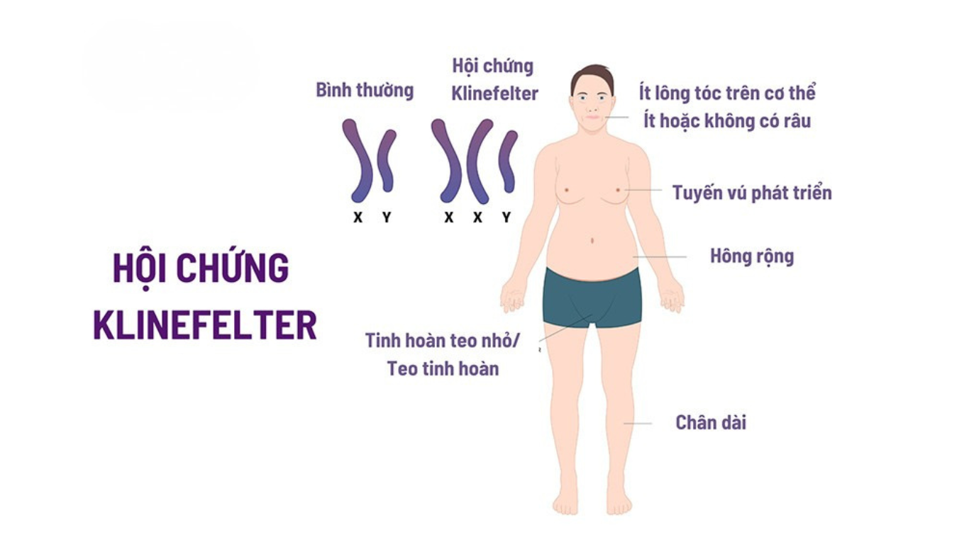 hội chứng Klinefelter