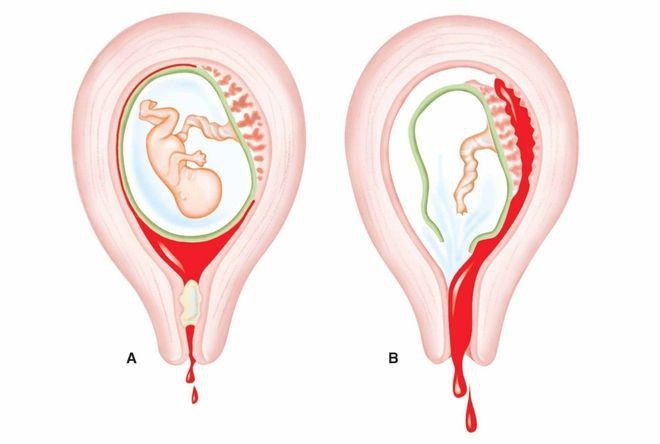 tại sao thai IVF hay ra máu