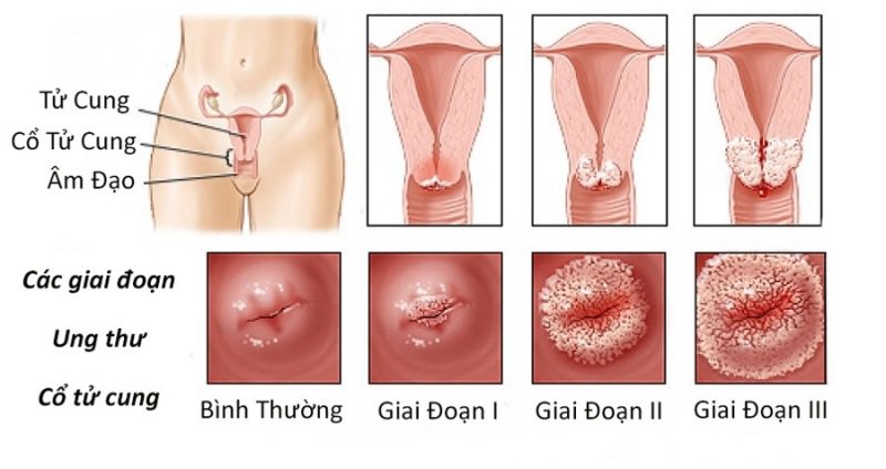 ung thư cổ tử cung