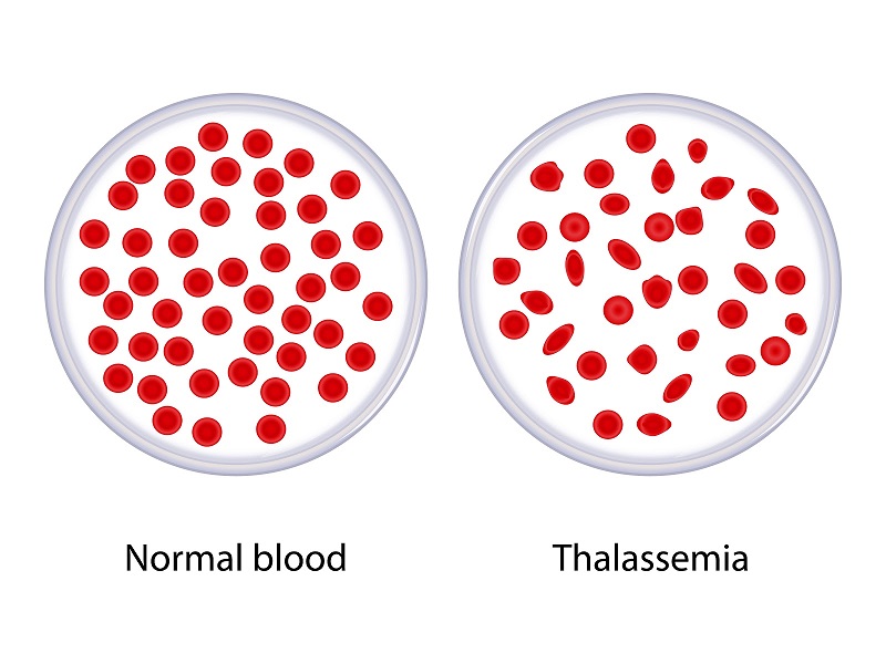 Bệnh Thalassemia Tan Máu Bẩm Sinh