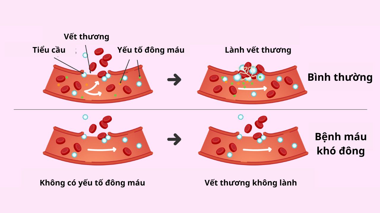 Bệnh máu khó đông là gì