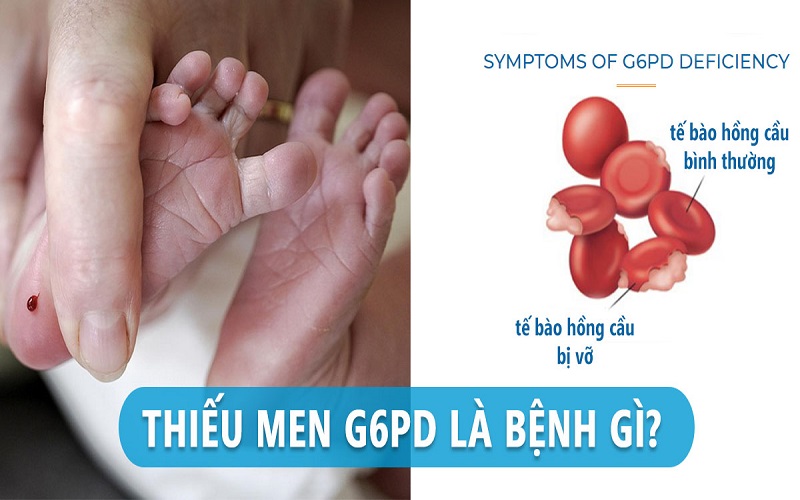Bệnh thiếu men G6PD