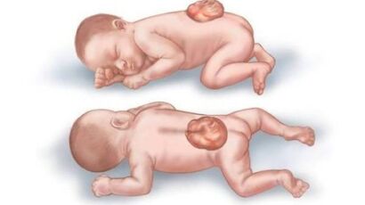 Dị tật ống thần kinh