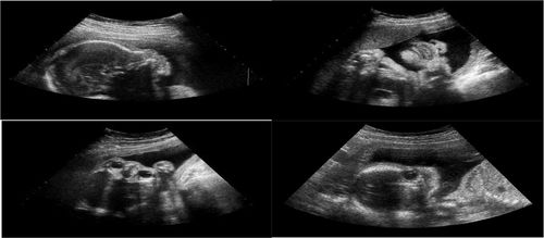Dị tật ống thần kinh gây ra bệnh gì