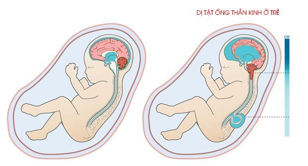Dị tật ống thần kinh là gì
