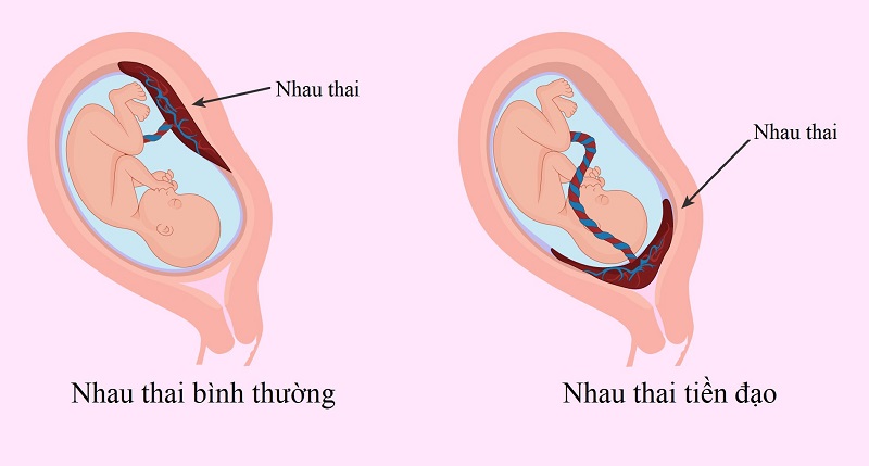 Hiện tượng bánh nhau khu trú