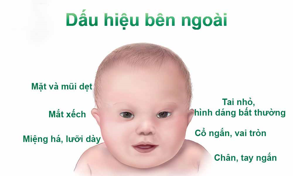 Làm Sao Để Nhận Biết Trẻ Bị Down Thể Nhẹ Từ Sớm