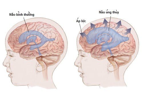 Não úng thủy