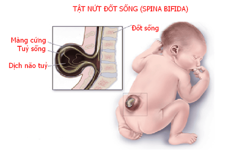 Nguyên nhân dị tật ống thần kinh