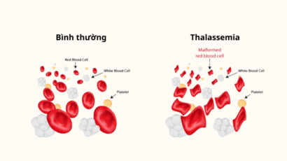 Thalassemia là gì