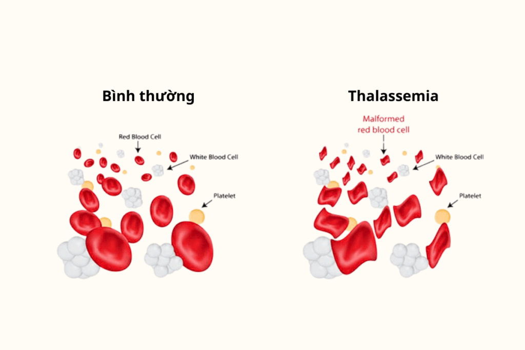 Thalassemia là gì
