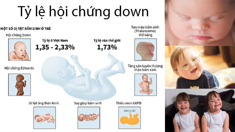 Trẻ Bị Down Sống Được Bao Lâu