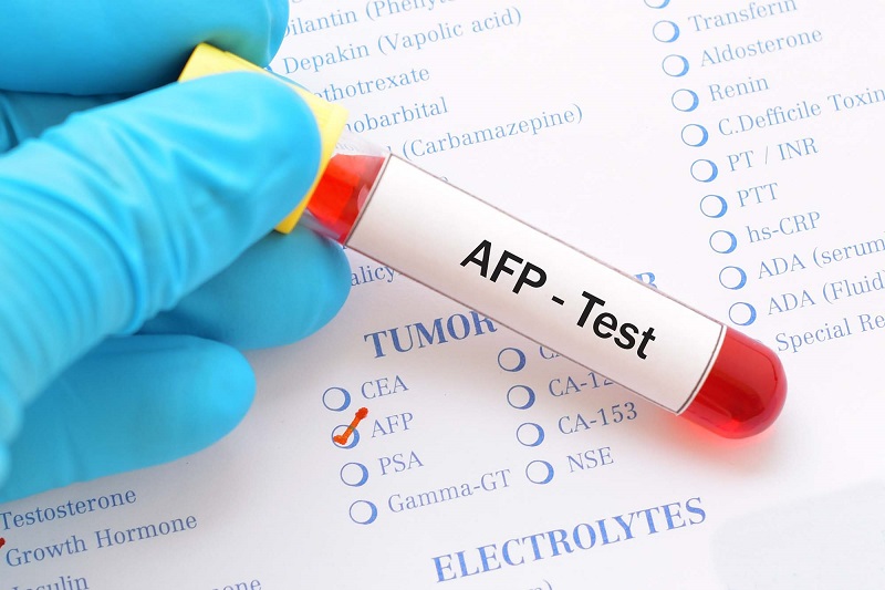 Triple test nguy cơ dị tật ống thần kinh cao
