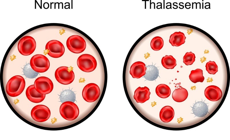 gen Thalassemia (Tan máu bẩm sinh)