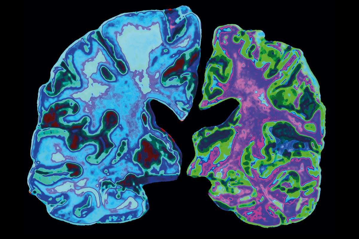nguy cơ mắc bệnh Alzheimer