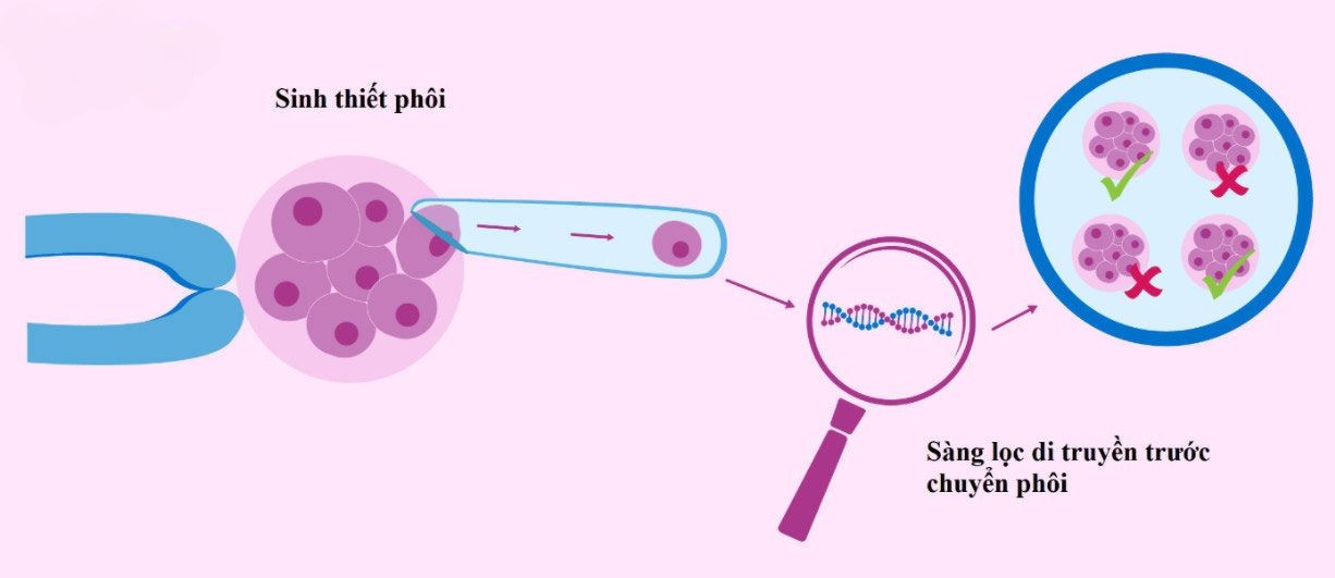 Chi phí sàng lọc phôi 