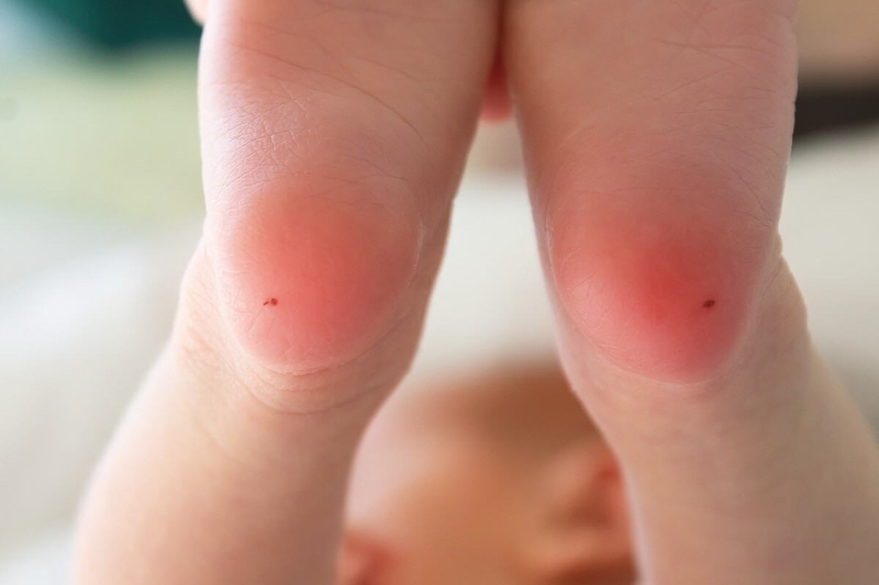 thời điểm lấy máu gót chân cho trẻ