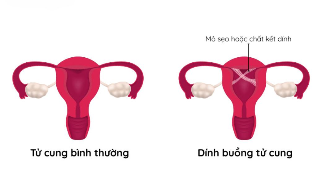 Dính buồng tử cung để lâu có sao không