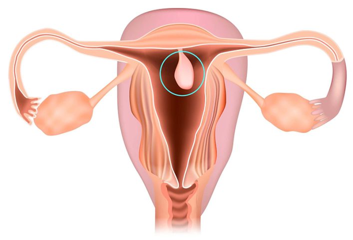 Polyp nội mạc tử cung là gì