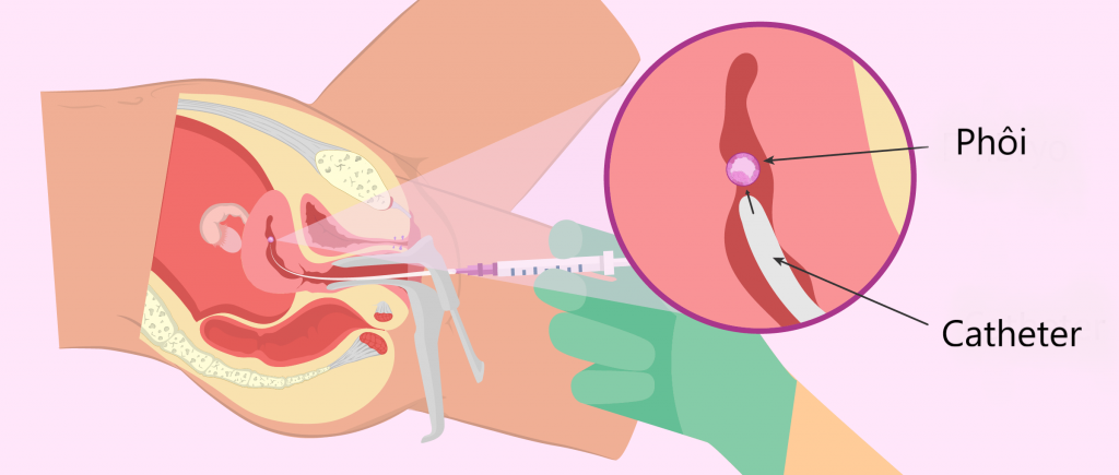 chuyển phôi IVF là gì