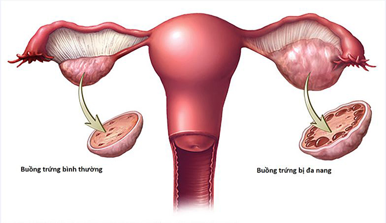 hội chứng buồng trứng đa nang