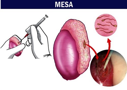 phẫu thuật MESA
