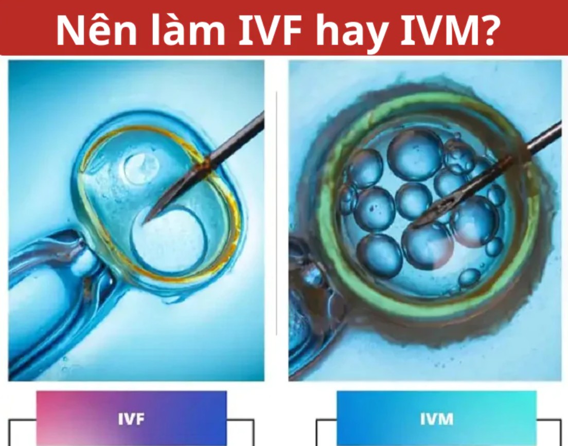 Kỹ Thuật Làm IVM